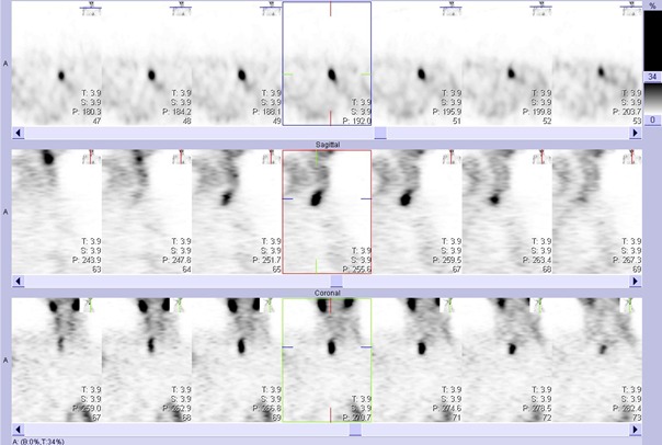 Obr. č. 2: Tomografická scintigrafie krku 33 minut po aplikaci radioindikátoru