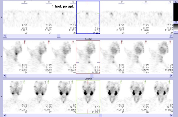 Obr. č. 2: Tomografická scintigrafie krku 60 minut po aplikaci radioindikátoru