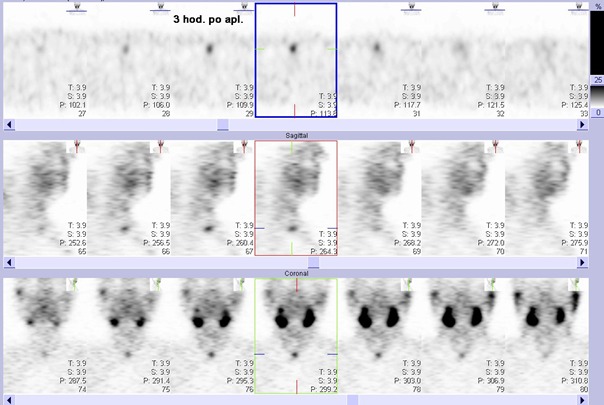 Obr. . 3: Tomografick scintigrafie krku 3 hodiny po aplikaci radioindiktoru