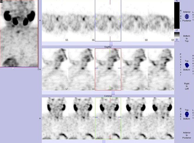 Obr. . 3: Tomografick scintigrafie krku 180 minut po aplikaci radioindiktoru