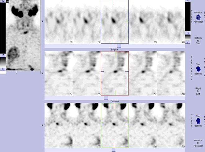Obr. . 3: Tomografick scintigrafie krku 190 minut po aplikaci radioindiktoru