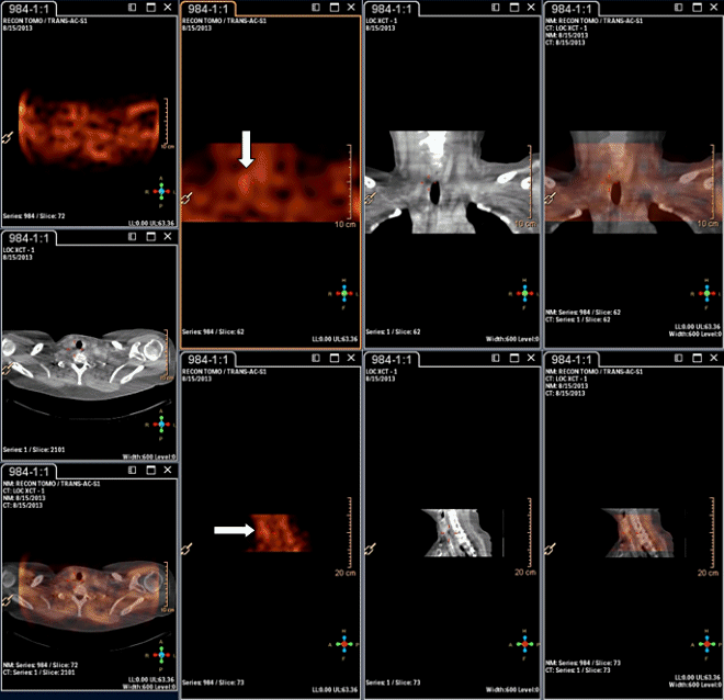 Obr.2.: Scintigrafie pomoc 99mTc-MIBI metodou SPECT/CT  se zetelnou patologickou loiskovou depozic radiofarmaka v blzkosti dolnho plu pravho laloku ttn lzy.