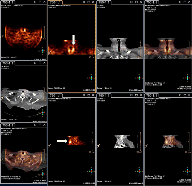 Obr.2.: Scintigrafie pomoc 99mTc-MIBI metodou SPECT/CT  se zetelnou patologickou loiskovou depozic radiofarmaka v blzkosti hornho plu levho laloku ttn lzy.
