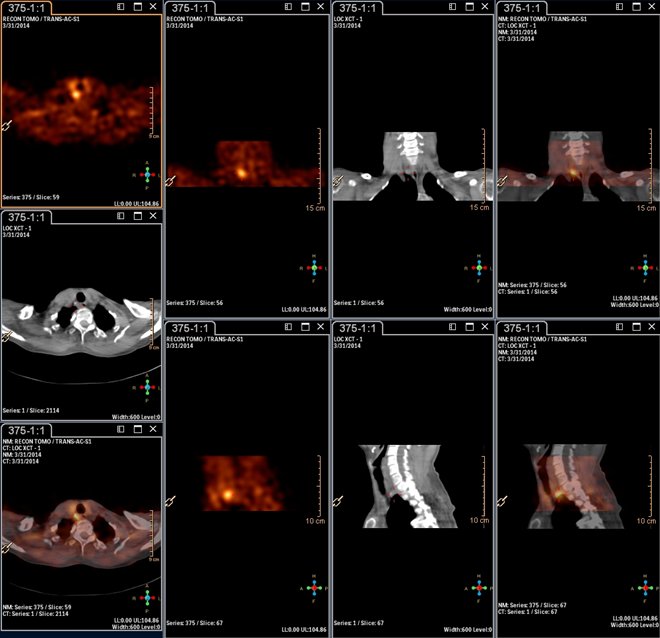Obr.3.: Scintigrafie pomoc 99mTc-MIBI metodou SPECT/CT  se zetelnou patologickou loiskovou depozic radiofarmaka dorzomediln od dolnho plu pravho laloku ttn lzy.