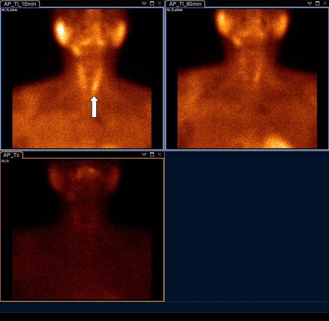 Obr.1.: Planrn scintigrafie v AP projekci pomoc 99mTc-pertechnettu (vlevo dole) a 99mTc-MIBI (1.fze vlevo nahoe, 2.vpravo nahoe) se zetelnou akumulac MIBI v blzkosti dolnho plu levho laloku ttn lzy a zpomalenm vyplavovnm radiofarmaka.