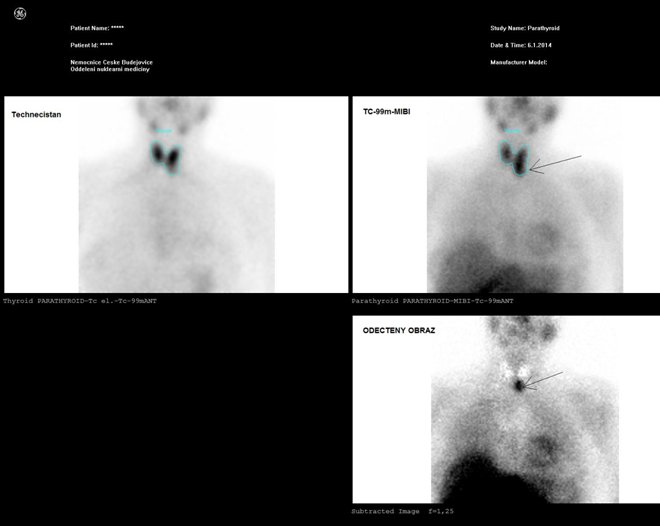 Obr..1: Planrn scintigrafie v AP projekci pomoc 99mTc-pertechnettu (vlevo nahoe) a 99mTc-MIBI (1. fze vpravo nahoe) se zetelnou akumulac MIBI v blzkosti dolnho plu levho laloku ttn lzy a zpomalenm vyplavovnm radiofarmaka  viz odetn obraz vpravo dole.