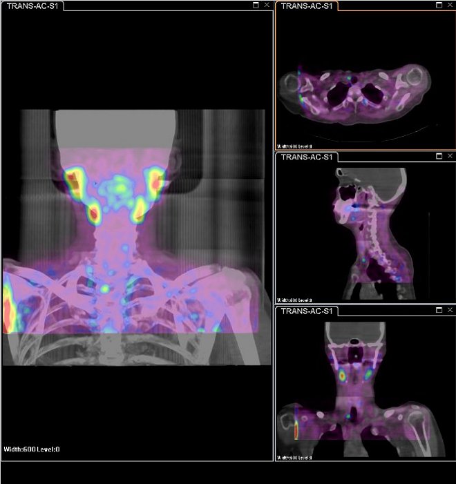 Obr.3: Scintigrafie pomoc 99mTc-MIBI metodou SPECT/ldCT (General MPR fusion) se zetelnou patologickou loiskovou depozic radiofarmaka  lokalizovanou  ventrokaudln od dolnho plu pravho laloku ttnice.