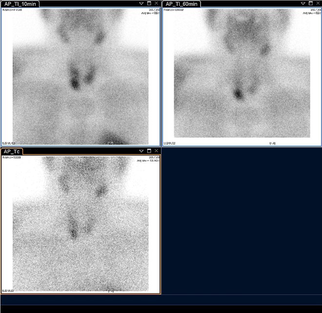 Obr.1.: Planrn scintigrafie vAP projekci pomoc 99mTc-pertechnettu (vlevo dole) a 99mTc-MIBI (1.fze vlevo nahoe, 2.vpravo nahoe), kde zachycena oblast  patologicky akumulujc radiofarmakon (Tc-MIBI)  se zpomalenm vymvnm projikujc se kdolnmu plu pravho laloku ttnice.