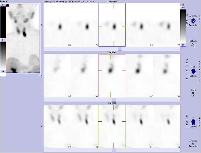 Obr..1: Tomografick scintigrafie krku a mediastina 20 minut po aplikaci radioindiktoru. Horn ada: transverzln  ezy, prostedn ada snmk: sagitln  ezy, doln ada: ezy koronrn. Vlevo nahoe sumace koronrnch ez.