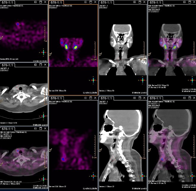 Obr.3.: Scintigrafie pomoc 99mTc-MIBI metodou SPECT/ldCT  s  patologickou loiskovou depozic radiofarmaka  pidolnm plu pravho laloku ttnice.