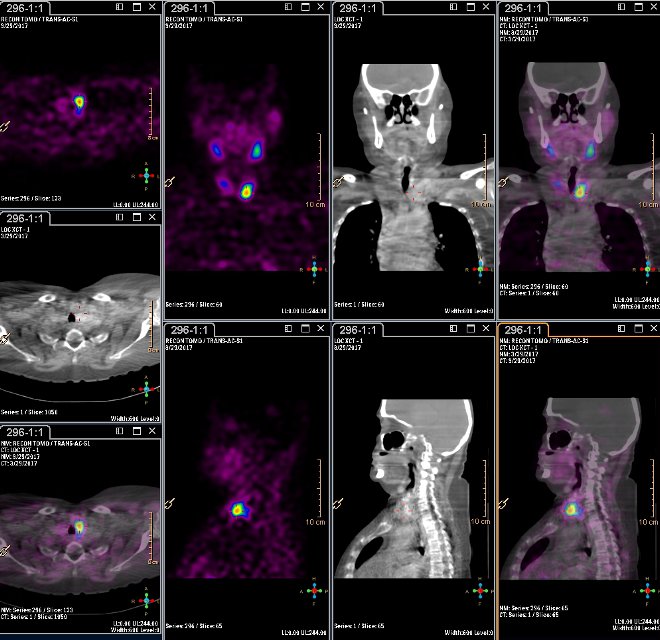 Obr.3.: Scintigrafie pomoc 99mTc-MIBI metodou SPECT/ldCT  s  patologickou loiskovou depozic radiofarmaka  pi dolnm plu levho laloku ttnice.