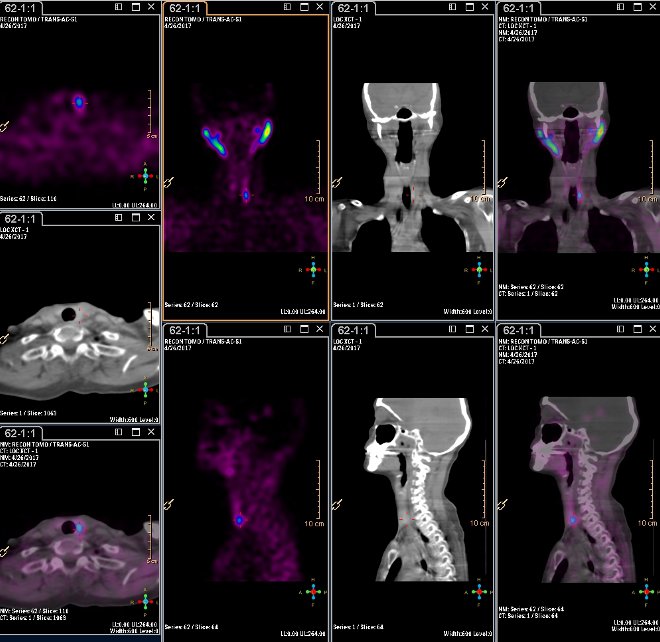 Obr.3.: Scintigrafie pomoc 99mTc-MIBI metodou SPECT/ldCT  s  patologickou loiskovou depozic radiofarmaka  pi dorzlnm okraji dolnho plu levho laloku ttnice.