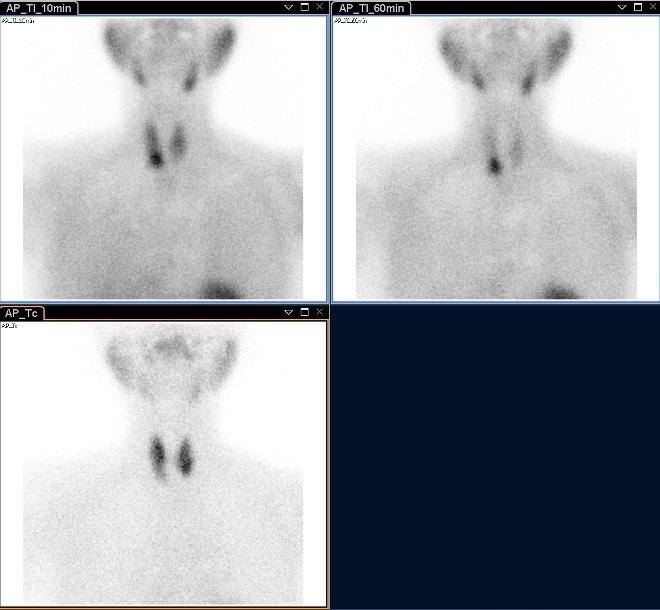 Obr.1.: Planrn scintigrafie v AP projekci pomoc 99mTc-pertechnettu (vlevo dole) a 99mTc-MIBI (1.fze vlevo nahoe, 2.vpravo nahoe), kde zachycena patologick akumulace Tc-MIBI se zpomalenm vymvnm vpravo dole.