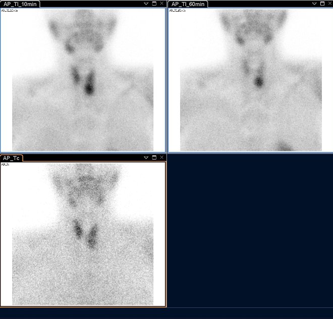 Obr.1.: Planrn scintigrafie v AP projekci pomoc 99mTc-pertechnettu (vlevo dole) a 99mTc-MIBI (1. fze vlevo nahoe, 2. vpravo nahoe), kde zachycena patologick akumulace Tc-MIBI se zpomalenm vymvnm vlevo dole.