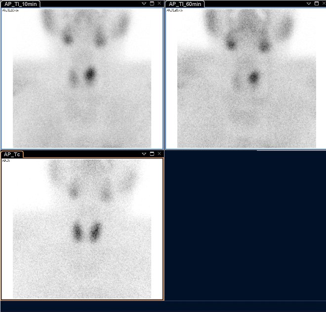 Obr.1.: Planrn scintigrafie vAP projekci pomoc 99mTc-pertechnettu (vlevo dole) a 99mTc-MIBI (1.fze vlevo nahoe, 2.vpravo nahoe), kde zachycena patologick akumulace Tc-MIBI se zpomalenm vymvnm vlevo nahoe.