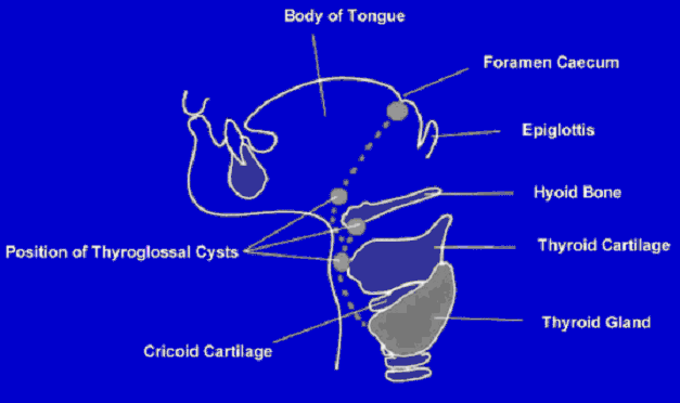 Obr. . 3: Znzornn prbhu ductus thyreoglossus a nejastjho umstn mediln krn cysty