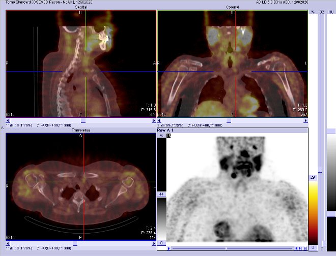 Obr.2.: Scintigrafie pomoc 99mTc-MIBI metodou SPECT/ldCT  se zetelnou patologickou loiskovou depozic radiofarmaka  lokalizovanou  ventrokaudln od dolnho plu levho laloku ttnice.