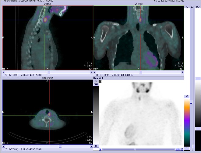 Obr.2.: Scintigrafie pomoc 99mTc-MIBI metodou SPECT/ldCT  se zetelnou patologickou loiskovou depozic radiofarmaka  lokalizovanou  dorzln od hornho plu levho laloku ttnice.