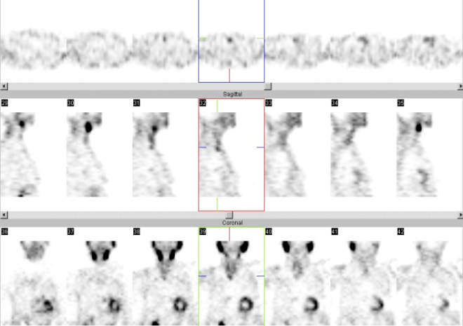 Obr. č. 4: Tomografická scintigrafie krku 187 minut po aplikaci radioindikátoru. Horní řada: transverzální řezy, prostřední řada snímků: sagitální řezy, dolní řada: řezy koronální.