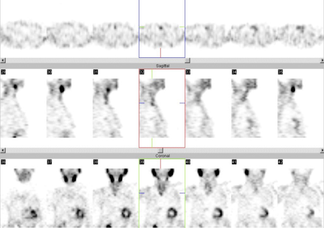 Obr. . 4: Tomografick scintigrafie krku 187 minut po aplikaci radioindiktoru. Horn ada: transverzln ezy, prostedn ada snmk: sagitln ezy, doln ada: ezy koronln.