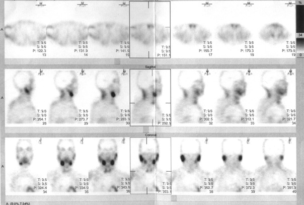 Obr. . 4: Tomografick scintigrafie krku 185 minut po aplikaci radioindiktoru