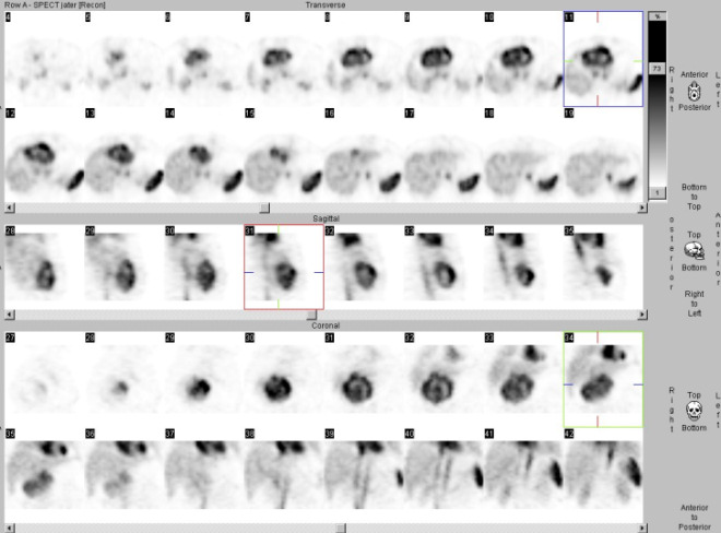 Obr. č. 1: Tomografická scintigrafie jater. Ve dvou horních řádcích řezy transverzální, v prostřední řadě řezy sagitální, v dolních dvou řadách řezy koronální