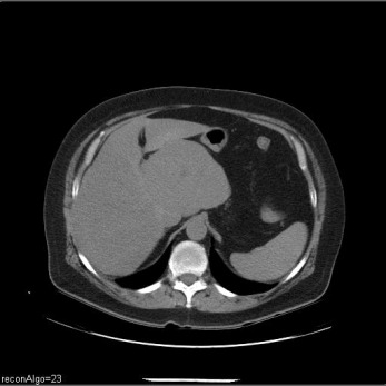 Obr. . 1: CT jater nativn