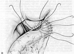 Obr. č. 6: Portoenteroanastomóza – Kasaiova operace