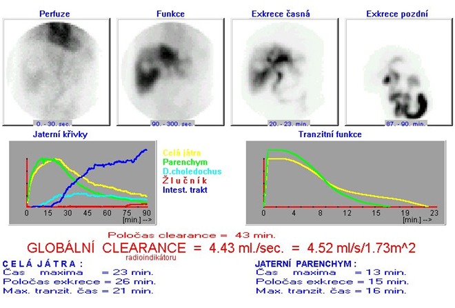 Obr. . 1: Dynamick scintigrafie jater a luovch cest  cholescintigrafie. 