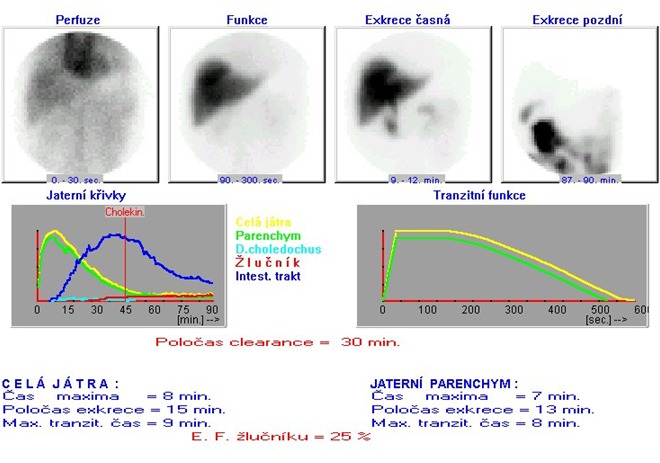 Obr. . 3: Dynamick scintigrafie jater a luovch cest  cholescintigrafie.