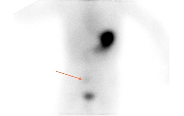 Obr. 1 Časný snímek po aplikaci, šipka označuje ložisko patologického vychytávání RF
