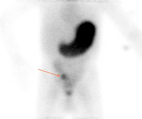 Obr. 2 Pozdní snímek, šipka opět označuje ložisko patologického vychytávání RF