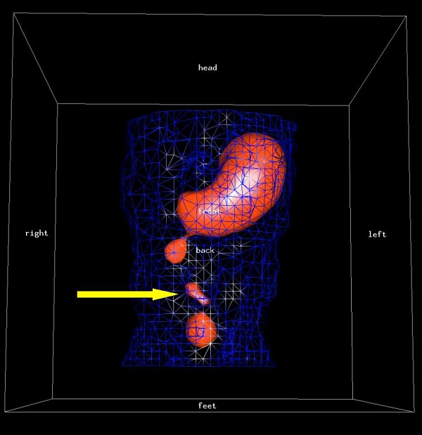 Obr. 3 SPECT - 3D rekonstrukce ve dvouprahovém zobrazení