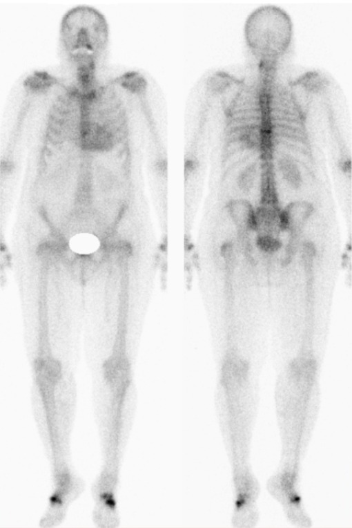 Obr. 1: Scintigrafie skeletu tto pacientky