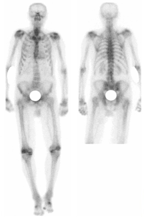 Obr. 2: Scintigrafie skeletu u tohoto pacienta