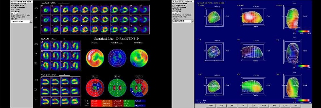 Obr. . 7: Gatovan tomografick scintigrafie myokardu na kamee Intevo Siemens s tomografickm systmem IQ-SPECT smultifoklnmi kolimtory SMARTZOOM.