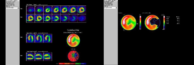 Obr. . 8: Gatovan tomografick scintigrafie myokardu na kamee Intevo Siemens s tomografickm systmem IQ-SPECT smultifoklnmi kolimtory SMARTZOOM.