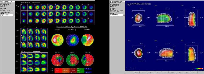 Obr. . 5: Gatovan tomografick scintigrafie myokardu na kamee Intevo Siemens s tomografickm systmem IQ-SPECT s multifoklnmi kolimtory SMARTZOOM.