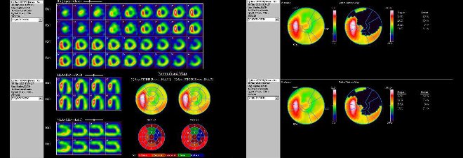 Obr. . 6: Gatovan tomografick scintigrafie myokardu na kamee Intevo Siemens s tomografickm systmem IQ-SPECT s multifoklnmi kolimtory SMARTZOOM.