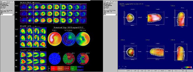 Obr. . 8: Gatovan tomografick scintigrafie myokardu na kamee Intevo Siemens s tomografickm systmem IQ-SPECT smultifoklnmi kolimtory SMARTZOOM.