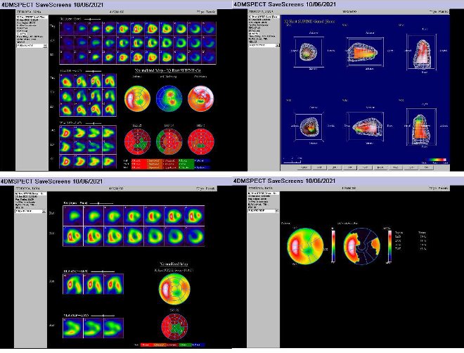 Obr. . Gatovan tomografick scintigrafie myokardu na kamee Intevo Siemens s tomografickm systmem IQ-SPECT s multifoklnmi kolimtory SMARTZOOM.