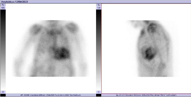 Obr.č.1: Statická scintigrafie hrudníku v přední a levé boční projekci. Vyšetření 3 hodiny po aplikaci radiofarmaka.
