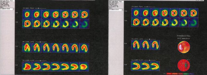 Obr. č. 2: Gatovaná tomografická scintigrafie myokardu.