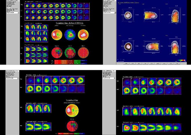 Obr.3: Gatovaná tomografická scintigrafie myokardu na kameře Intevo Siemens s tomografickým systémem IQ-SPECT s multifokálními kolimátory SMARTZOOM.