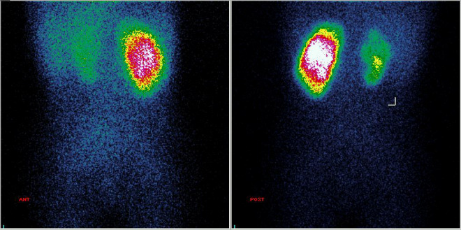 Obr. 1.: Statická scintigrafie ledvin s 99mTc-DMSA z přední a zadní projekce na 500 000 imp. Svráštělá ledvina vpravo s redukcí funkčního parenchymu.