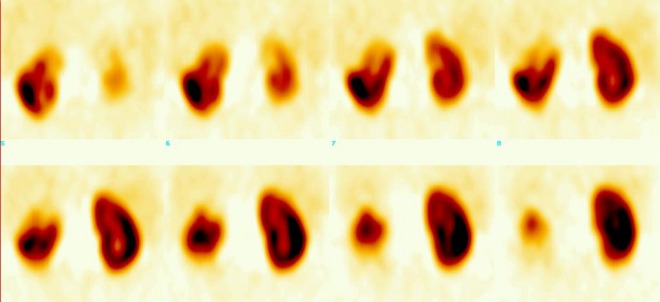 Obr. 4.: SPECT ledvin, koronrn ezy.