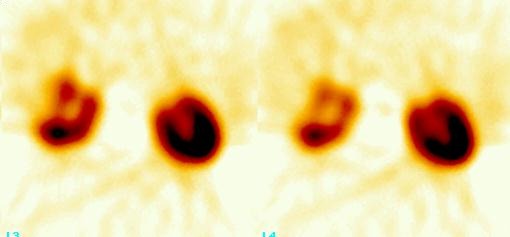 Obr. 7.: SPECT ledvin, transversln ezy.