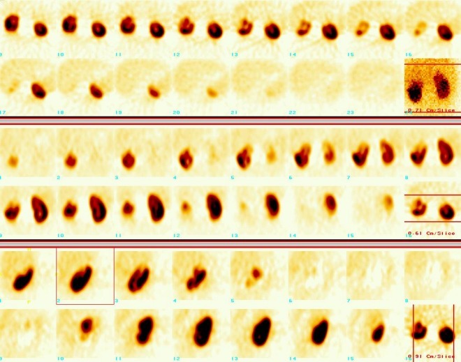 Obr. 3.: SPECT ledvin.