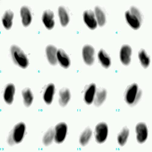 Obr. 8.: SPECT ledvin, 3D rekonstrukce.