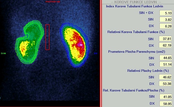 Obr. 3. Indexy korov tubulrn funkce a relativn korov tubulrn funkce.